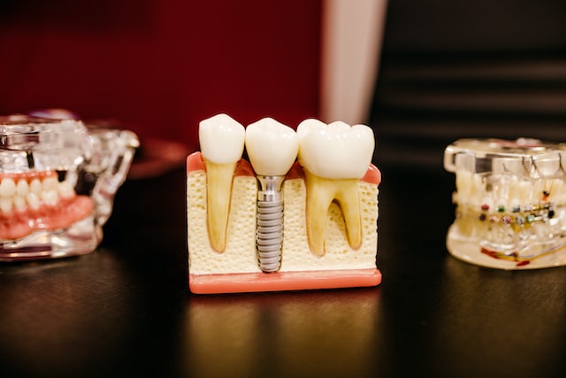 Why Are Dental Implants So Expensive?